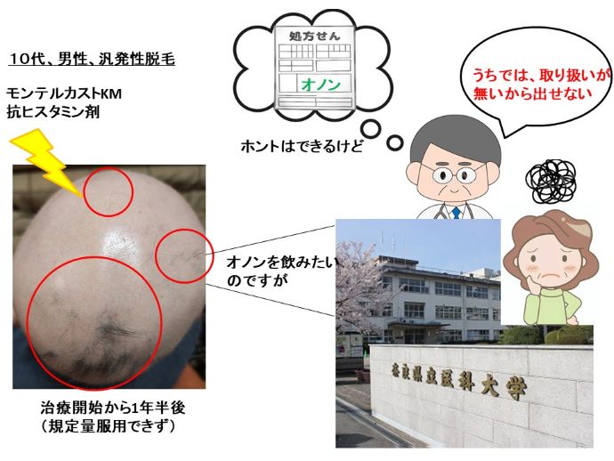 円形脱毛症　病院